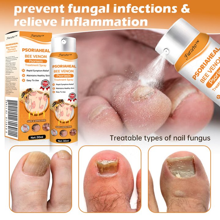 Furzero™ PsoriaHeal Bee Venom Psoriasis Treatment Spray(Suitable for all skin conditions)