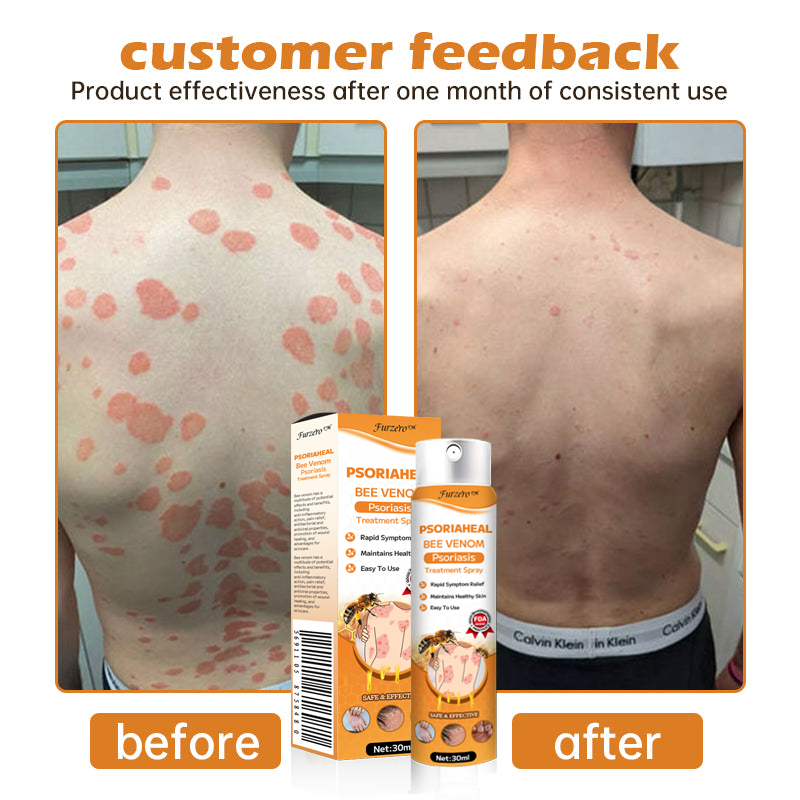 Furzero™ PsoriaHeal Bee Venom Psoriasis Treatment Spray(Suitable for all skin conditions)