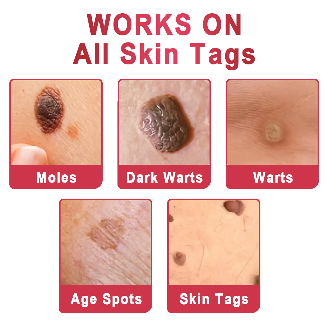 KISSHI™ WipeOffEase Tags & Moles Remover🌟Special Deals🌟