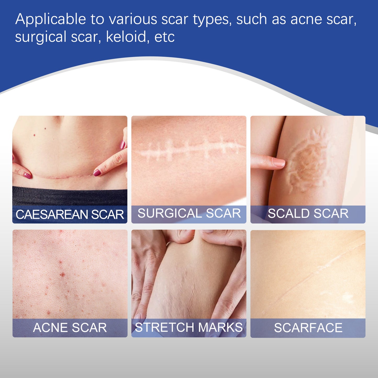 SILICONE SCAR SHEETS [SCAR REDUCTION THERAPHY]