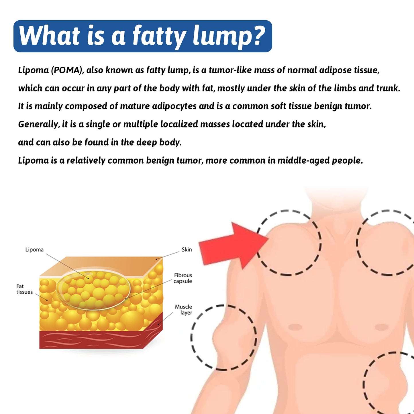 [South Moon Lipoma Cream]New generation Fat Dissolving Cream !!